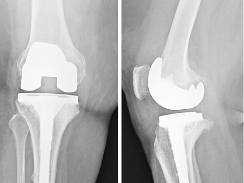 Knee Replacement Details